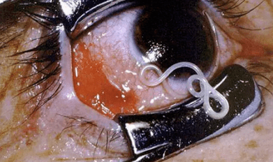 Tipuri de paraziți în corpul uman